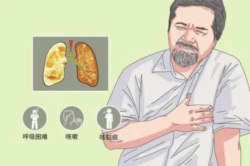 左侧中量胸腔积液严重吗？深入解析与应对策略